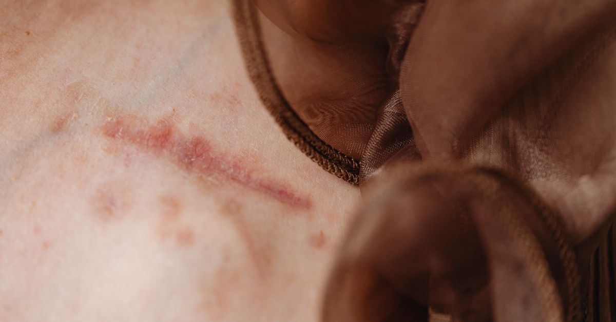 Zadbana blizna, spokojniejszy połóg: praktyczny przewodnik po pielęgnacji po cesarskim cięciu
